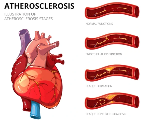 aterosclerosis, infarto agudo de miocardio, la angina de pecho y la muerte súbita